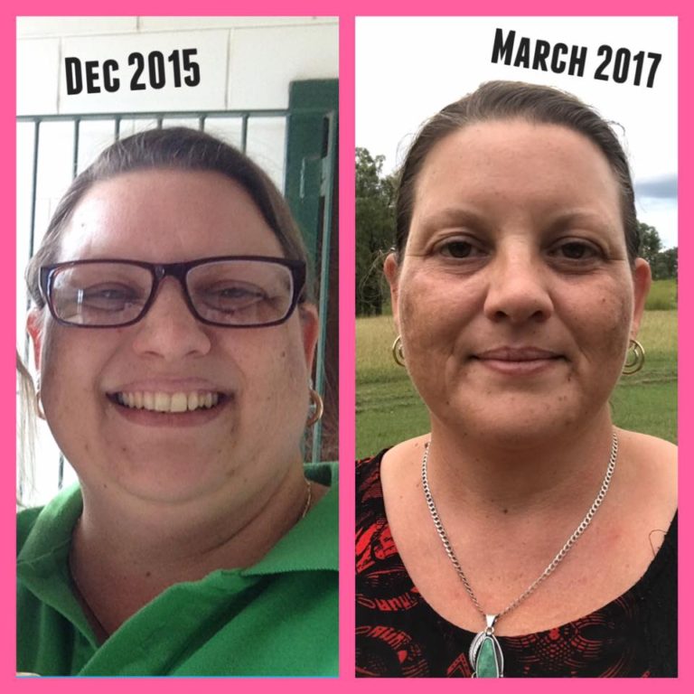 Hypothyroid in photos-Before and After - Stop The Thyroid Madness