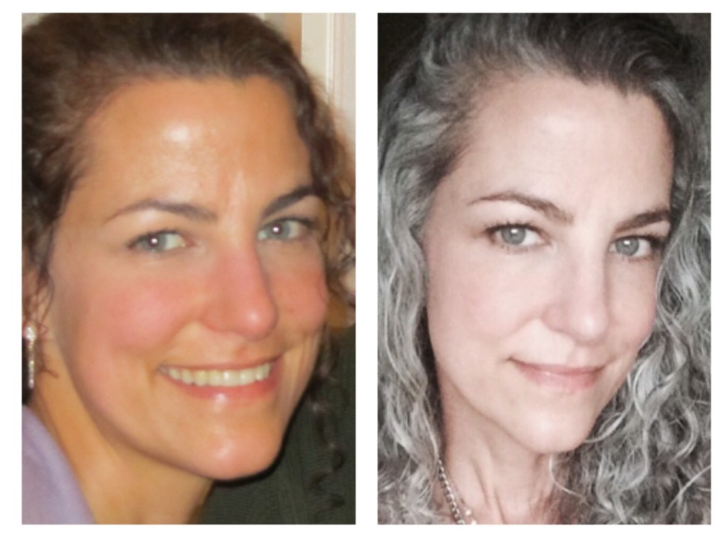 Hypothyroid In Photos Before And After Stop The Thyroid Madness 