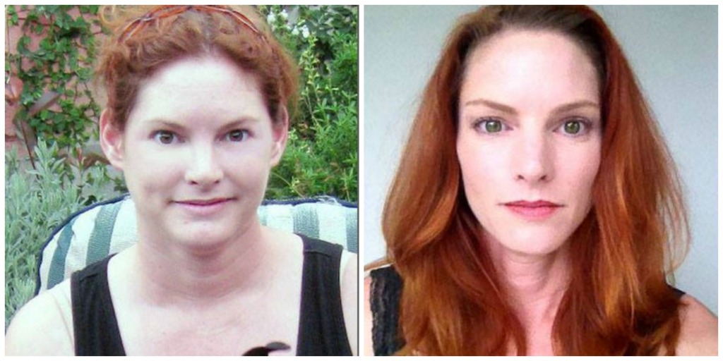 Hypothyroid in photos-Before and After - Stop The Thyroid Madness