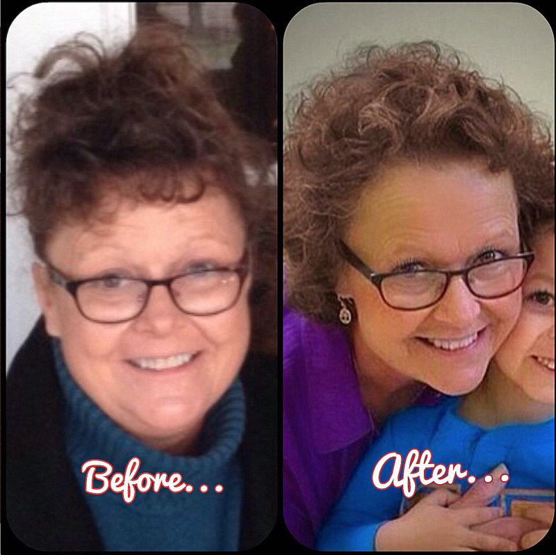 Hypothyroid in photos-Before and After - Stop The Thyroid Madness